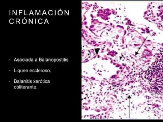 I N F L A M A C I Ó N
C R Ó N I C A
• Asociada a Balanopostitis
• Liquen escleroso.
• Balanitis xerótica
obliterante.
 