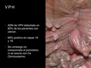 V P H
• ADN de VPH detectado en
80% de los pacientes con
cáncer.
• 69% positivo en cepas 16
y 18.
• Sin embargo no
compromete el pronóstico
ni se asocia con Ca
Cérvicouterino.
 