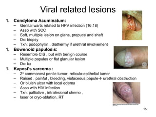 15
Viral related lesions
1. Condyloma Acuminatum:
– Genital warts related to HPV infection (16,18)
– Asso with SCC
– Soft, multiple lesion on glans, prepuce and shaft
– Dx: biopsy
– Txn: podophyllin , diathermy if urethral involvement
1. Bowenoid papulosis:
– Resemble CIS , but with benign course
– Multiple papules or flat glanular lesion
– Dx: bx
1. Kaposi’s sarcoma :
– 2nd
commonest penile tumor, reticulo-epithelial tumor
– Raised , painful , bleeding, violaceous papule urethral obstruction
– Or bluish ulcer with local edema
– Asso with HIV infection
– Txn: palliative , intralesional chemo ,
– laser or cryo-ablation, RT
 