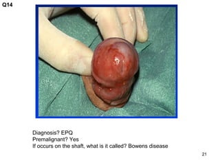 21
Q14
Diagnosis? EPQ
Premalignant? Yes
If occurs on the shaft, what is it called? Bowens disease
 