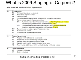 24
What is 2009 Staging of Ca penis?
SCC penis invading prostate is T3
 