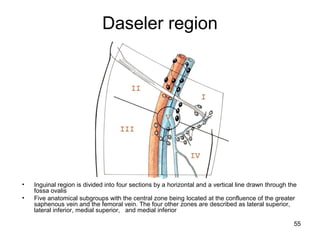 55
Daseler region
• Inguinal region is divided into four sections by a horizontal and a vertical line drawn through the
fossa ovalis
• Five anatomical subgroups with the central zone being located at the confluence of the greater
saphenous vein and the femoral vein. The four other zones are described as lateral superior,
lateral inferior, medial superior, and medial inferior
 