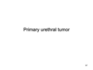 97
Primary urethral tumorPrimary urethral tumor
 