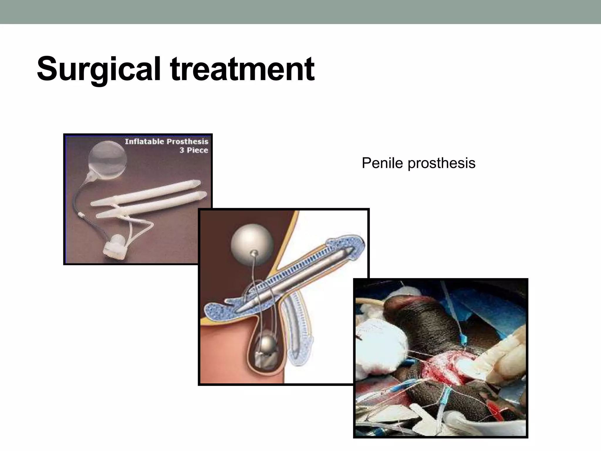 Surgical treatment
Penile prosthesis
 