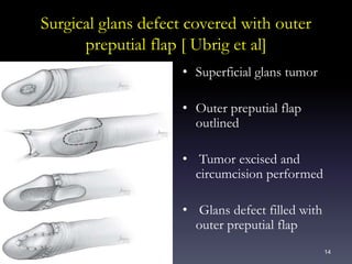 14
Surgical glans defect covered with outer
preputial flap [ Ubrig et al]
• Superficial glans tumor
• Outer preputial flap
outlined
• Tumor excised and
circumcision performed
• Glans defect filled with
outer preputial flap
 