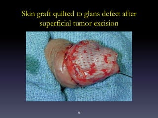 15
Skin graft quilted to glans defect after
superficial tumor excision
 