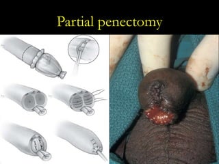 21
Partial penectomy
 