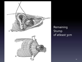 Remaining
Stump
of atleast 3cm
22
 