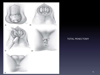 TOTAL PENECTOMY
24
 