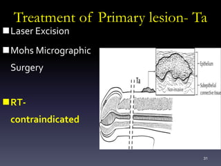 31
Treatment of Primary lesion- Ta
Laser Excision
Mohs Micrographic
Surgery
RT-
contraindicated
 