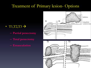 32
Treatment of Primary lesion- Options
• T1,T2,T3 
– Partial penectomy
– Total penectomy
– Emasculation
 