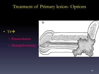 33
Treatment of Primary lesion- Options
• T4
– Emasculation
– Hemipelvectomy
 