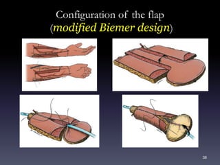 38
Configuration of the flap
(modified Biemer design)
 