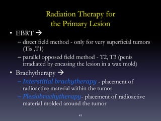 41
Radiation Therapy for
the Primary Lesion
• EBRT 
– direct field method - only for very superficial tumors
(Tis ,T1)
– parallel opposed field method - T2, T3 (penis
irradiated by encasing the lesion in a wax mold)
• Brachytherapy 
– Interstitial brachytherapy - placement of
radioactive material within the tumor
– Plesiobrachytherapy- placement of radioactive
material molded around the tumor
 