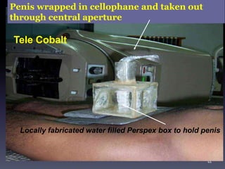 Locally fabricated water filled Perspex box to hold penis
Penis wrapped in cellophane and taken out
through central aperture
Tele Cobalt
44
 