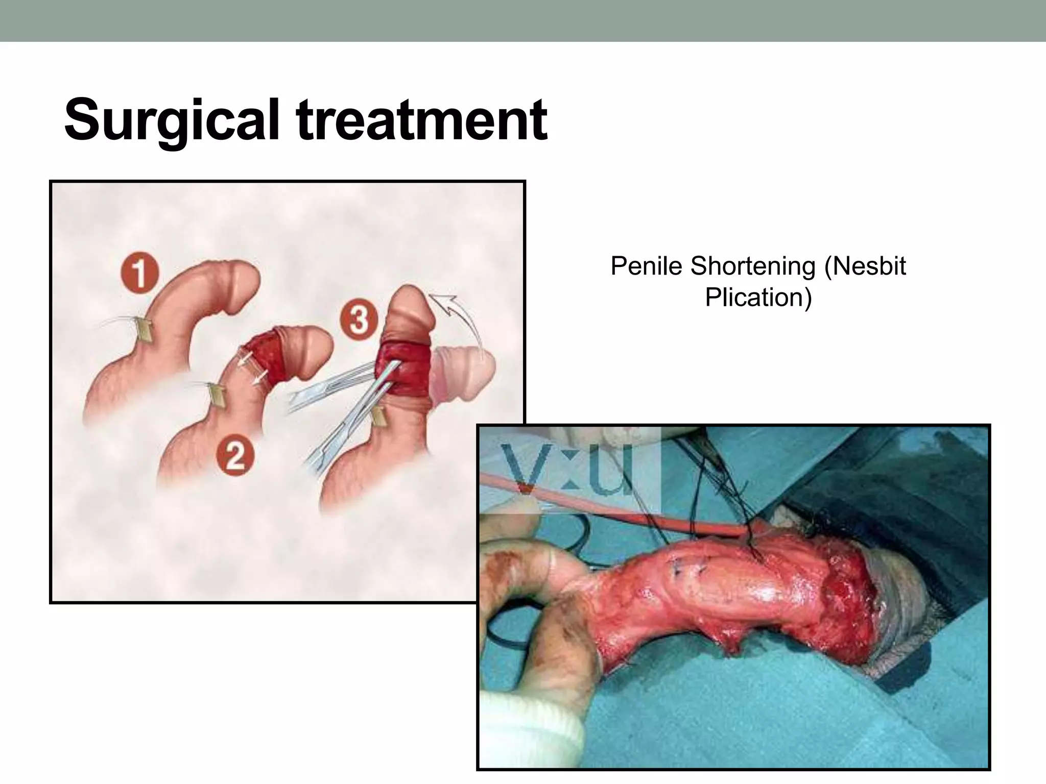 Surgical treatment
Penile Shortening (Nesbit
Plication)
 