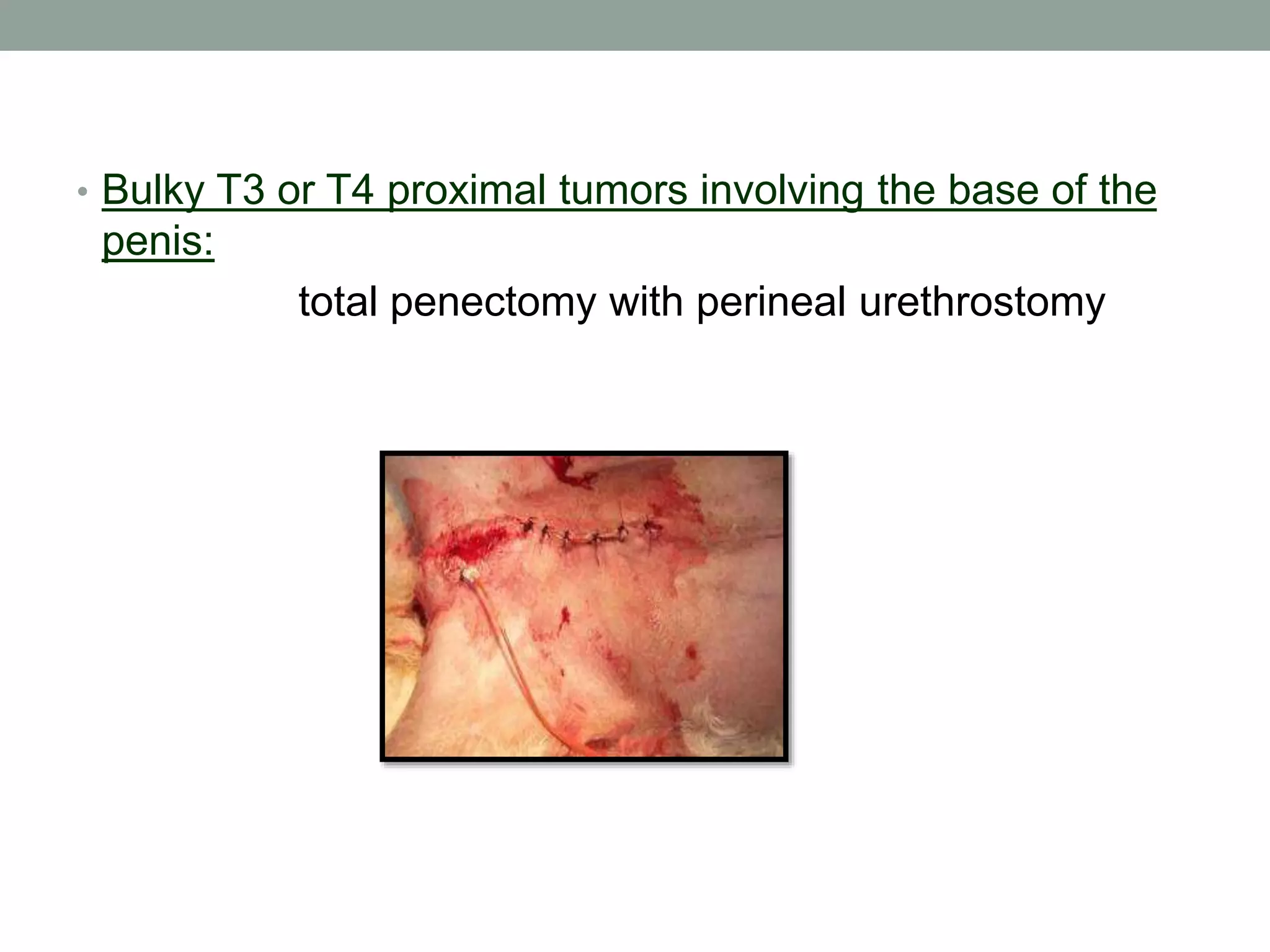 • Bulky T3 or T4 proximal tumors involving the base of the
penis:
total penectomy with perineal urethrostomy
 