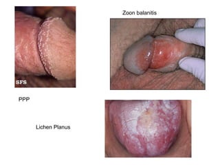 Zoon balanitis




PPP




      Lichen Planus




                                       14
 