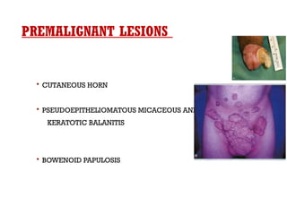 PREMALIGNANT LESIONS
 CUTANEOUS HORN
 PSEUDOEPITHELIOMATOUS MICACEOUS AND
KERATOTIC BALANITIS
 BOWENOID PAPULOSIS
 