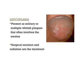 LEUCOPLAKIA
 Present as solitary or
multiple whitish plaques
that often involves the
meatus
 Surgical excision and
radiation are the treatment
 