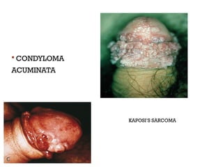  CONDYLOMA
ACUMINATA
 KAPOSI’S SARCOMA
 