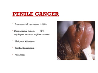 PENILE CANCER
 Squamous cell carcinoma. > 95%
 Mesenchymal tumors. < 3%
e.g Kaposi sarcoma, angiosarcoma etc
 Malignant Melanoma.
 Basal cell carcinoma.
 Metastasis.
 