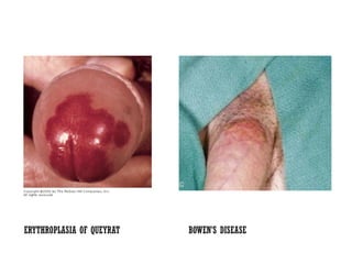 ERYTHROPLASIA OF QUEYRAT BOWEN’S DISEASE
 