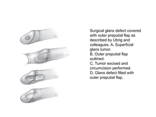 Surgical glans defect covered
with outer preputial flap as
described by Ubrig and
colleagues. A, Superficial
glans tumor.
B, Outer preputial flap
outlined.
C, Tumor excised and
circumcision performed.
D, Glans defect filled with
outer preputial flap.
 