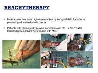 BRACHYTHERAPY
• Multicatheter interstitial high-dose rate brachytherapy (MHB) for patients
presenting a localized penile cancer.
• Patients with histologically proven, non-metastatic (T1-T2 N0-N2 M0)
localized penile cancer were treated with MHB.
 