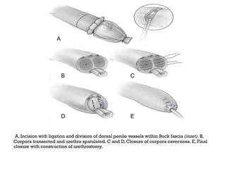 A, Incision with ligation and division of dorsal penile vessels within Buck fascia (inset). B,
Corpora transected and urethra spatulated. C and D, Closure of corpora cavernosa. E, Final
closure with construction of urethrostomy.
A
B C
D E
 