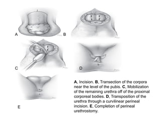 A, Incision. B, Transection of the corpora
near the level of the pubis. C, Mobilization
of the remaining urethra off of the proximal
corporeal bodies. D, Transposition of the
urethra through a curvilinear perineal
incision. E, Completion of perineal
urethrostomy.
A B
C D
E
 