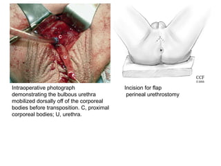 Intraoperative photograph
demonstrating the bulbous urethra
mobilized dorsally off of the corporeal
bodies before transposition. C, proximal
corporeal bodies; U, urethra.
Incision for flap
perineal urethrostomy
 
