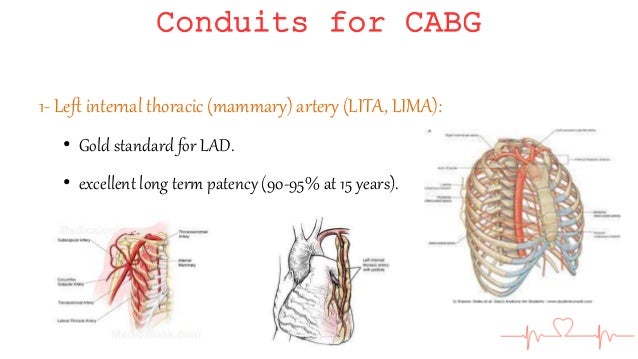 cabg