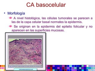 CA basocelular
• Morfología
 A nivel histológica, las células tumorales se parecen a
las de la capa celular basal normales la epidermis.
 Se originan en la epidermis del epitelio folicular y no
aparecen en las superficies mucosas.
 