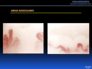 Capilaroscopia 2007