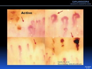 Capilaroscopia 2007