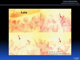 Capilaroscopia 2007