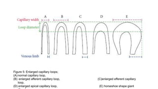 Figure 5: Enlarged capillary loops;
(A) normal capillary loop,
(B) enlarged afferent capillary loop, (C)enlarged efferent capillary
loop,
(D) enlarged apical capillary loop, (E) horseshoe shape giant
 