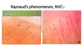 Raynaud’s phenomenon, NVC:-
 