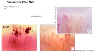 Scleroderma (SSc), NVC:-
2022 Indian Journal of Dermatology, Venereology and Leprology
 