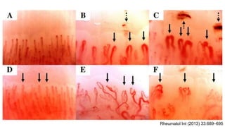 Rheumatol Int (2013) 33:689–695
 