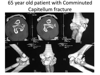 Capitellum fractures | PPTX