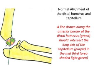 Double Capitulum Capitellum fractures | PPTX