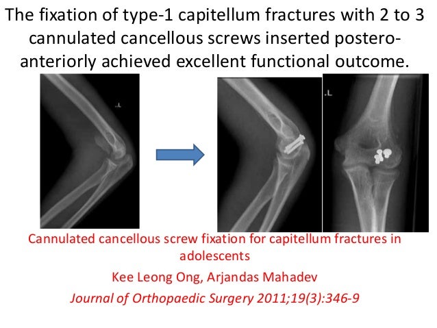 Capitellum fractures
