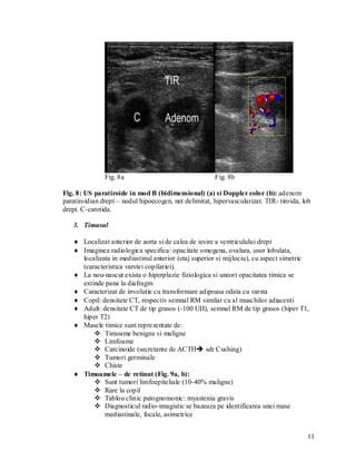 Fig. 8a                                 Fig. 8b

Fig. 8: US paratiroide in mod B (bidimensional) (a) si Doppler color (b): adenom
paratiroidian drept – nodul hipoecogen, net delimitat, hipervascularizat. TIR- tiroida, lob
drept. C-carotida.

   3. Timusul

    Localizat anterior de aorta si de calea de iesire a ventriculului drept
    Imaginea radiologica specifica: opacitate omogena, ovalara, usor lobulata,
     localizata in mediastinul anterior (etaj superior si mijlociu), cu aspect simetric
     (caracteristica varstei copilariei).
    La nou-nascut exista o hiperplazie fiziologica si uneori opacitatea timica se
     extinde pana la diafragm
    Caracterizat de involutie cu transformare adipoasa odata cu varsta
    Copil: densitate CT, respectiv semnal RM similar cu al muschilor adiacenti
    Adult: densitate CT de tip grasos (-100 UH), semnal RM de tip grasos (hiper T1,
     hiper T2)
    Masele timice sunt reprezentate de:
          Timoame benigne si maligne
          Limfoame
          Carcinoide (secretante de ACTH sdr Cushing)
          Tumori germinale
          Chiste
    Timoamele – de retinut (Fig. 9a, b):
          Sunt tumori limfoepiteliale (10-40% maligne)
          Rare la copil
          Tablou clinic patognomonic: myastenia gravis
          Diagnosticul radio-imagistic se bazeaza pe identificarea unei mase
             mediastinale, focale, asimetrice


                                                                                         11
 