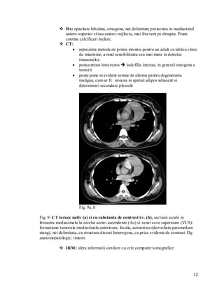  Rx: opacitate lobulata, omogena, net delimitate proiectata in mediastinul
             antero-superior si/sau antero- mijlociu, mai frecvent pe dreapta. Poate
             contine calcificari inelare.
            CT:
                  reprezinta metoda de prima intentie pentru un adult cu tablou clinic
                     de miastenie, avand sensibilitatea cea mai mare in detectia
                     timoamelor.
                  postcontrast intravenos  iodofilia intensa, in general omogena a
                     tumorii
                  poate pune in evident semne de alarma pentru degenerarea
                     maligna, cum ar fi: invazia in spatiul adipos adiacent si
                     determinari secundare pleurale




                       Fig. 9a, b

Fig. 9: CT torace nativ (a) si cu substanta de contrast i.v. (b), sectiuni axiale in
fereastra mediastinala la nivelul aortei ascendente (Ao) si venei cave superioare (VCS):
formatiune tumorala mediastinala anterioara, focala, asimetrica (dezvoltata paramedian
stang), net delimitata, cu structura discret heterogena, cu priza evidenta de contrast. Dg
anatomopatologic: timom.

            IRM: ofera informatii similare cu cele computer tomografice




                                                                                             12
 