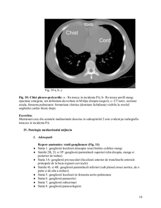 Fig. 10 a, b, c

Fig. 10: Chist pleuro-pericardic: a - Rx torace in incidenta PA; b- Rx torace profil stang:
opacitate omogena, net delimitata dezvoltata in MAIpe dreapta (sageti). c- CT nativ, sectiune
axiala, fereastra pulmonara: formatiune chistica (densitate lichidiana) vizibila la nivelul
unghiului cardio- frenic drept.

Exercitiu:
Mentionati care din semnele mediastinale descrise in subcapitolul 2 este evident pe radiografia
toracica in incidenta PA.

   IV. Patologia mediastinului mijlociu

           1. Adenopatii

               Repere anatomice: statii ganglionare (Fig. 11)
              Statia 1: ganglionii localizati deasupra venei brahio-cefalice stangi
              Statiile 2R, 2L si 3P: ganglionii paratraheali superiori (din dreapta, stanga si
               posterior de trahee)
              Statia 3A: ganglionii prevasculari (localizati anterior de trunchiurile arteriale
               principale de la baza regiunii cervicale)
              Statiile 4L si 4R: ganglionii paratraheali inferiori (sub planul crosei aortice, de o
               parte si de alta a traheei)
              Statia 5: ganglionii localizati in fereastra aorto-pulmonara
              Statia 6: ganglionii paraaortici
              Statia 7: ganglionii subcarinari
              Statia 8: ganglionii paraesofagieni


                                                                                                   14
 