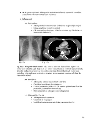  IRM : poate diferentia adenopatiile mediastino-hilare de structurile vasculare
     adiacente in situatiile cu rezultat CT echivoc

    Inflamatorii

               Tuberculoza:
                    Adenopatii hilare mai frecvent unilaterale, in special pe dreapta
                    Intreg ganglionul poate fi calcificat
                    CT: necroza (hipodensitate) centrala – cazeum (dg diferential cu
                      adenopatiile metastatice)




   Fig. 12a                        Fig. 12b

Fig. 12: Adenopatii tube rculoase: a-Rx toracic: opacitati mediastinale mijlocii cu
contur usor lobulat (sageti drepte); b- CT torace cu substanta de contrast, sectiune axiala,
fereastra mediastinala la nivelul bronsiilor principale: limfonoduli (Ggl) cu necroza
centrala si priza inelara de contrast, cu structura heterogena prin prezenta calcificarilor
(sageata incurbata).

               Sarcoidoza
                    Adenopatie hilare si mediastinale simetrice
                    Calcificari ganglionare in coaja de ou
                    Fibroza pulmonara (ATENTIE: pe masura aparitiei modificarilor
                       pulmonare, adenopatiile involueaza)
                    De regula exista si adenopatii subdiafragmatice

               Silicoza (Fig. 13a, b)
                     Adenopatii hilare simetrice
                     Calcificari in coaja de ou
                     Modificari pulmonare caracteristice pneumoconiozelor




                                                                                          16
 