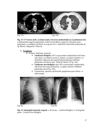 Fig. 13a                                     Fig. 13b

Fig. 13: CT torace nativ, sectiuni axiale, fereastra mediastinala (a) si pulmonara (b):
a-limfonoduli (sageti) mediastinali vizibili in loja Bareti, respective fereastra aorto-
pulmonara, cu multiple calcificari in coaja de ou; b- modificari interstitiale pulmonare de
tip fibrotic. Diagnostic: Silicoza.

    Neoplazice
         Primare: limfoame, leucemii
                Limfoame Hodgkin : 85% au prezentare mediastinala sub forma
                 unei mase cu contururi convexe, lineare, cu aspect asimetric, cu
                 delimitare imprecisa spre parenchimul pulmonar (infiltrare
                 pulmonara sub forma unor “limbi de flacari”) (Fig. 14a)
                Limfoame non-Hodgkin: doar 20% au prezentare mediastinala,
                 sub forma unei mase policiclice, cu aspect simetric (infiltrare
                 pulmonara rara) (Fig. 14b)
                Caracteristic: aparitia calcificarilor ganglionare post chimio- si
                 radio-terapie




Fig.14a                                     Fig.14b

Fig. 14 Adenopatii tumorale (sageti): a. Rx torace – Limfom Hodgkin. b. Tomografie
plana – Limfom Non-Hodgkin



                                                                                        17
 