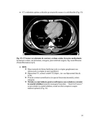  CT: evidentiere optima a efectelor pe structurile osoase si a calcificarilor (Fig. 15)




Fig. 15: CT torace cu s ubstanta de contrast, sectiune axiala, fereastra mediastinala :
formatiuni ovalare, net delimitate, omogene, paravertebrale (sageti). Dg: neurofibroame
(Neurofibromatoza tip I).

    IRM:
        Mase tumorale de forma fusiforma (cele cu origine ganglionara) sau
          sferica (cele cu origine in nervi periferici)
        Hiposemnal T1, semnal variabil T2 (hiper-, izo- sau hiposemnal fata de
          LCR)
        Priza de contrast semnificativa (in special feocromocitoamele), relativ
          omogena
        Metoda cea mai indicata pentru confirmarea sau excluderea extensiei
          in canalul rahidian (tumorile neurogene bisaculare – “dumb-bell tumors”
          se pot extinde in canalul rahidian, avand un efect compresiv asupra
          maduvei spinarii) (Fig. 16)




                                                                                        19
 